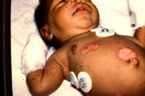 Epidermolysis Bullosa Letalis (4)