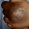 Epidermolysis Bullosa Simplex (2)