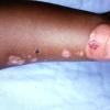 Epidermolysis Bullosa Simplex