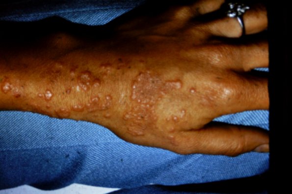 Erythema Exodantium Multiforme (2)