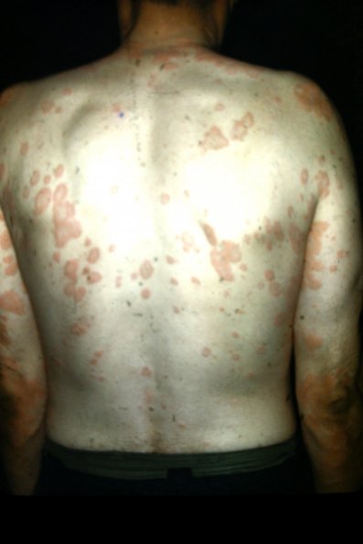 Erythema Multiforme (18)