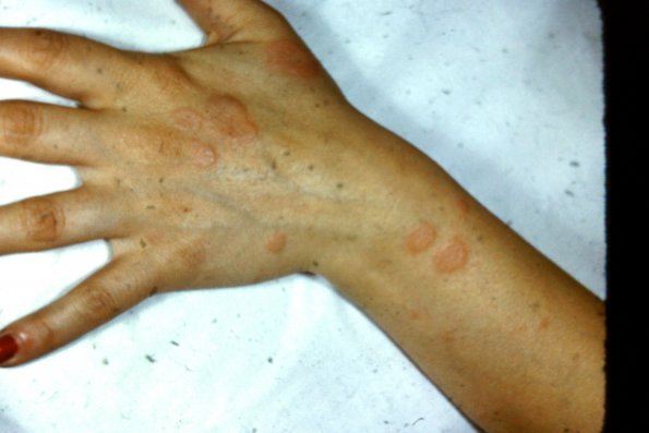 Erythema Multiforme (19)