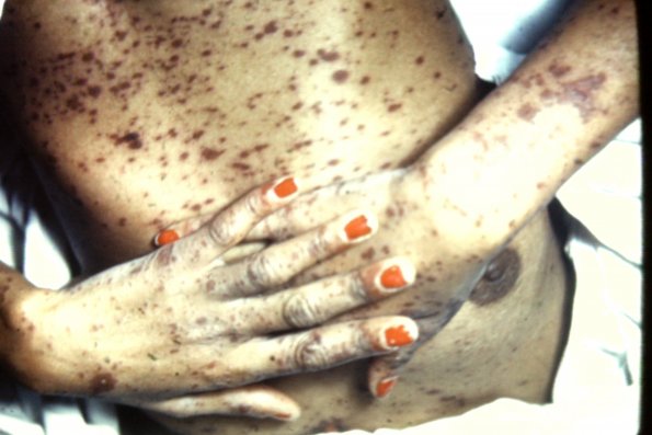 Erythema Multiforme (27)