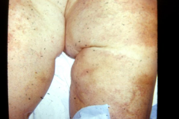 Erythema Multiforme (28)