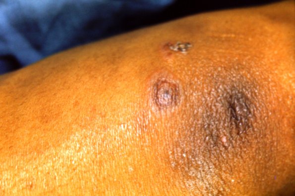 Erythema Multiforme (3)