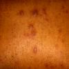 Erythema Multiforme (30)