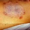 Erythema Multiforme (33)