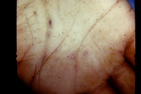 Erythema Multiforme (42)