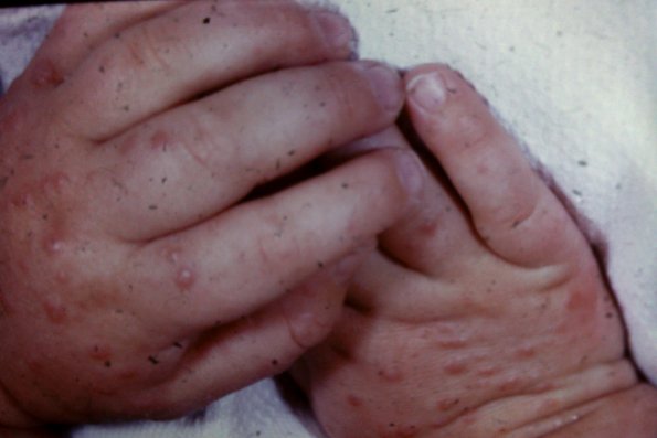 Erythema Multiforme (43)