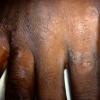 Erythema Multiforme (46)