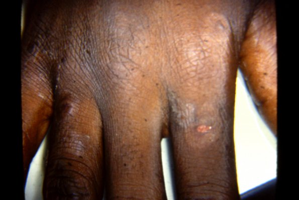 Erythema Multiforme (46)