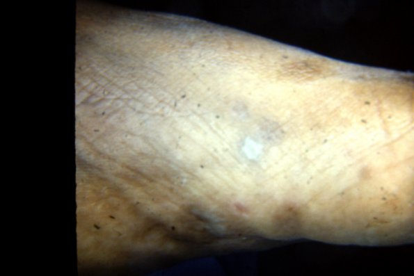 Erythema Multiforme (49)