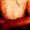 Erythema Multiforme (50)