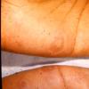 Erythema Multiforme (51)