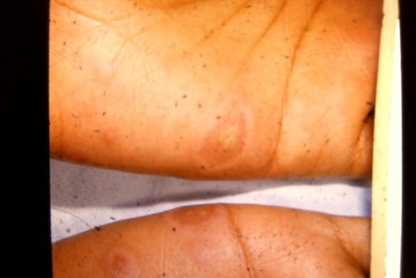 Erythema Multiforme (51)