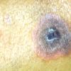 Erythema Multiforme