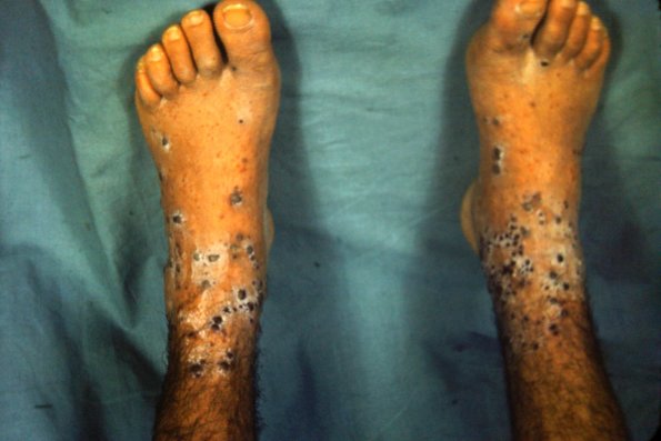 Hemorhagic Erythema Multiforme