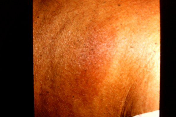 Erythema Nodosum (11)