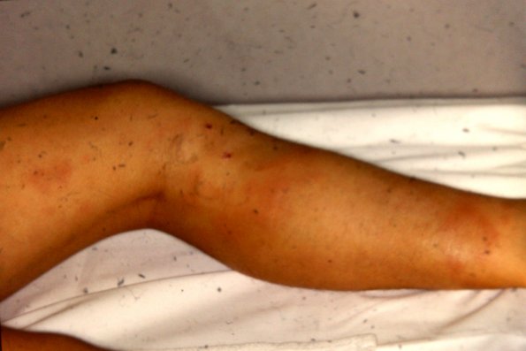 Erythema Nodosum (21)