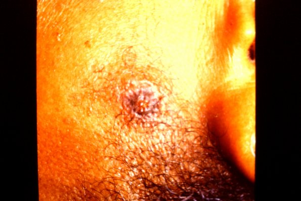 Granuloma (2)