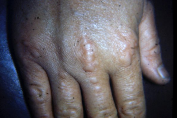 Granuloma Annulare (32)