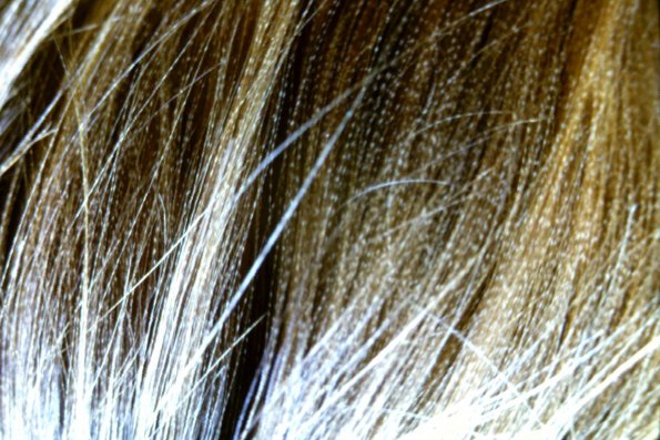 Pili Annulati Ringed Hair