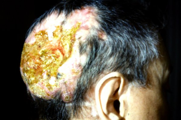 HEmangioenodtheliosarcoma