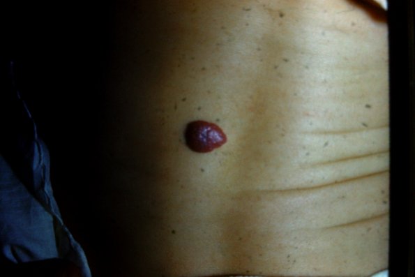 Strawberry Hemangioma