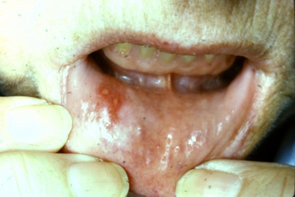 Herpes Simplex (7)