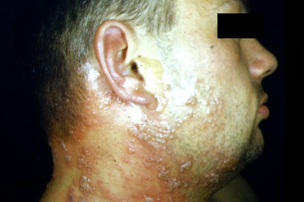 Herpes Zoster (5)
