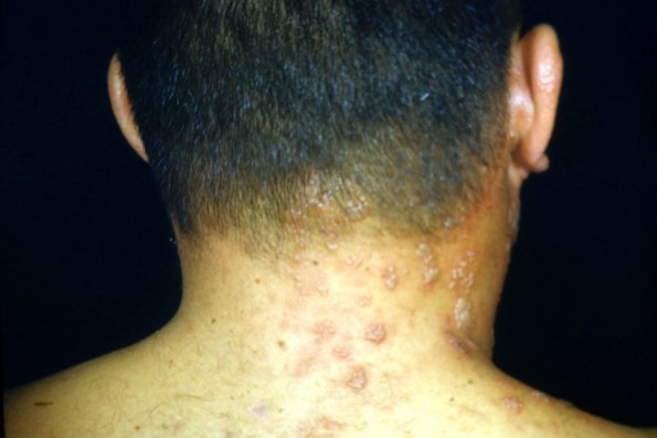 Herpes Zoster (6)