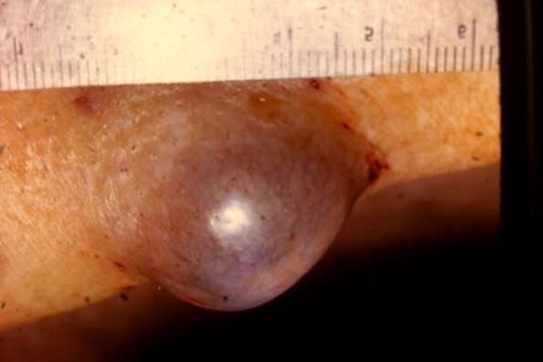 Benign Cystic Hidradenoma