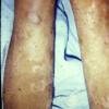 Congenital Ichthyosis (3)