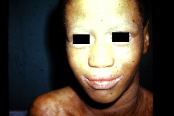 Congenital Ichthyosis (4)