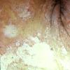 Congenital Ichthyosis (5)