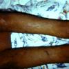 Congenital Icthyosis Erythroderma