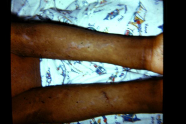 Congenital Icthyosis Erythroderma