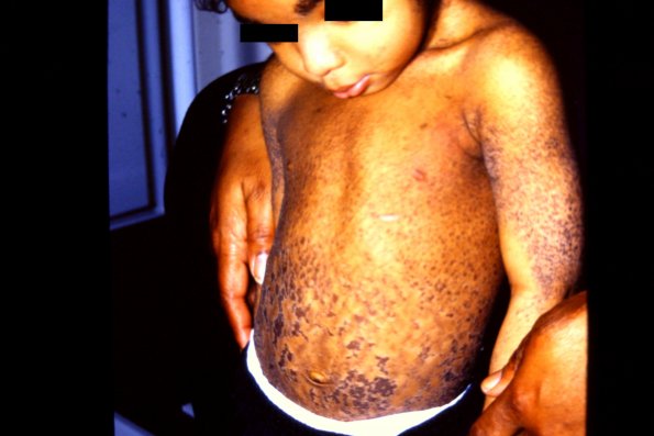 X-linked Ichthyosis