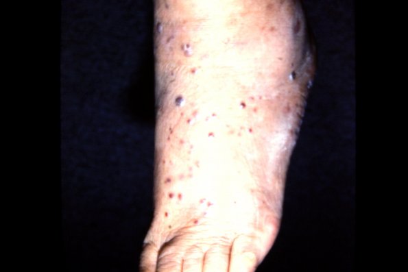 Kaposi's Sarcoma (4)