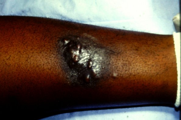 Kaposi's Sarcoma