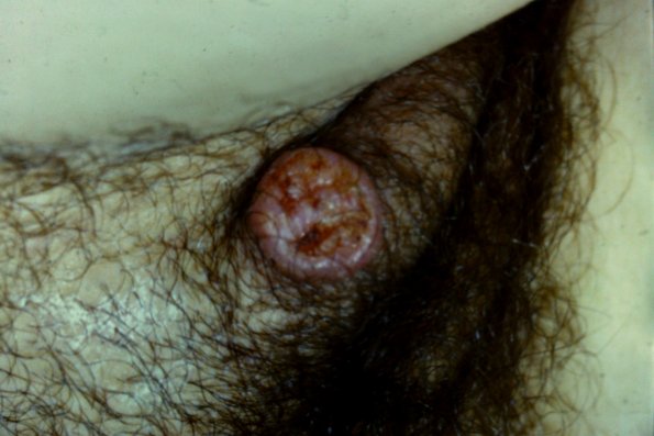 Vulva Keratoacanthoma