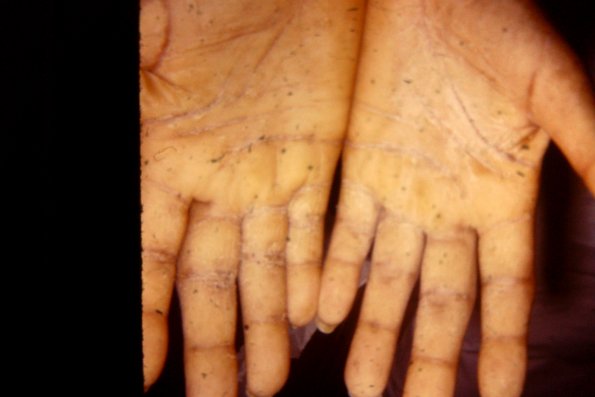 Keratoderma Climactericum