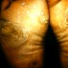 Keratoderma Plantare