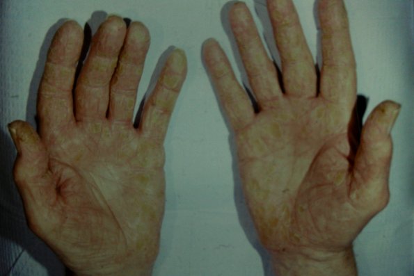 Keratoderma blenorrhagica after Rx