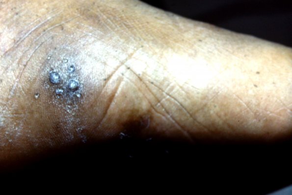 Punctate Keratoderma (4)