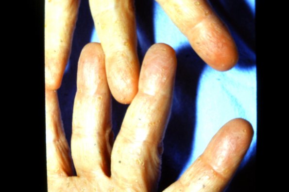 Punctate Keratoderma