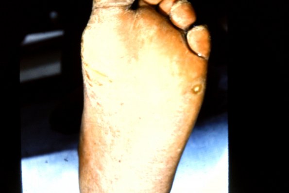 Striate-Linear Keratoderma