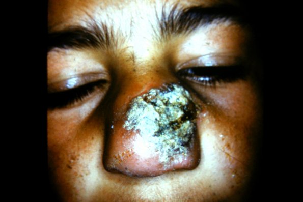 Leishmaniasis (13)