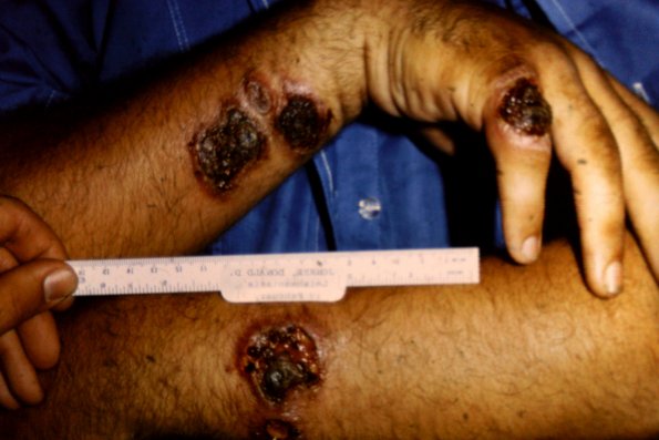 Leishmaniasis (18)