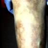 Lepromatous Leprosy (3)